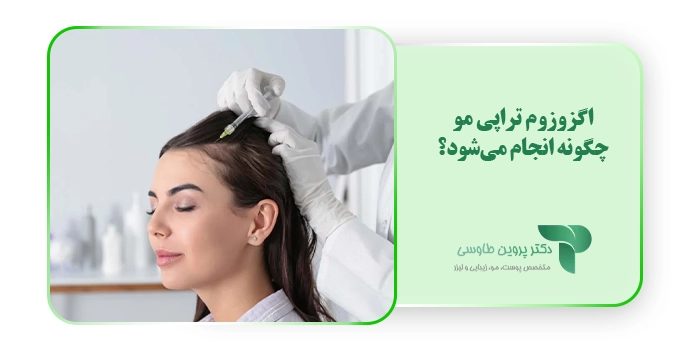 اگزوزوم تراپی مو چگونه انجام می‌شود؟