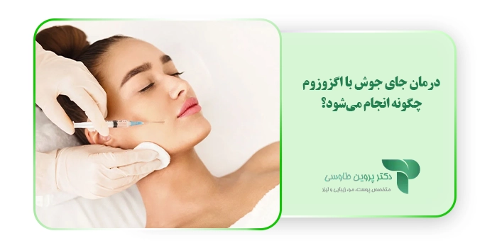 درمان جای جوش با اگزوزوم چگونه انجام می‌شود؟
