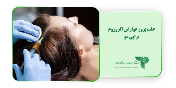 علت بروز عوارض اگزوزوم تراپی مو