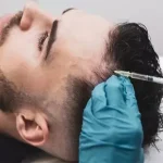 عوارض اگزوزوم تراپی مو