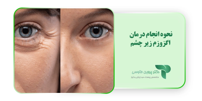 نحوه انجام درمان اگزوزم زیر چشم