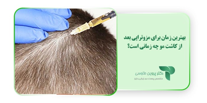 بهترین زمان برای مزوتراپی بعد از کاشت مو چه زمانی است؟