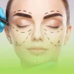 زاویه سازی صورت با تزریق چربی