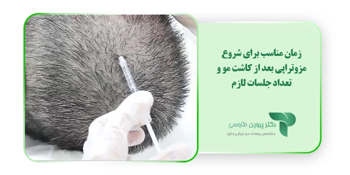 زمان مناسب برای شروع مزوتراپی بعد از کاشت مو و تعداد جلسات لازم