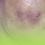 عوارض تزریق چربی به صورت
