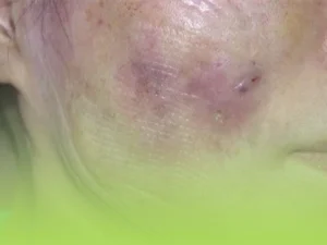 عوارض تزریق چربی به صورت