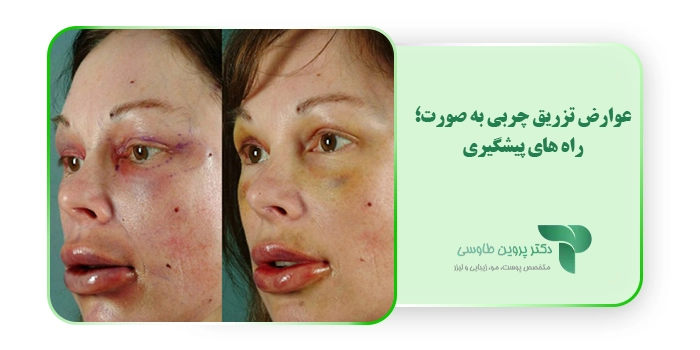 عوارض تزریق چربی به صورت؛ راه های پیشگیری