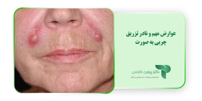 عوارض مهم و نادر تزریق چربی به صورت