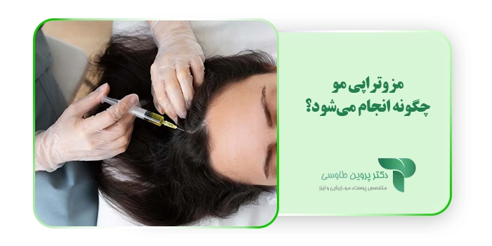 مزوتراپی مو چگونه انجام می‌شود؟