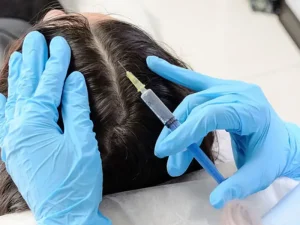 عوارض مزوتراپی مو