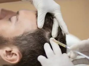 مراقبت‌های بعد از مزوتراپی مو