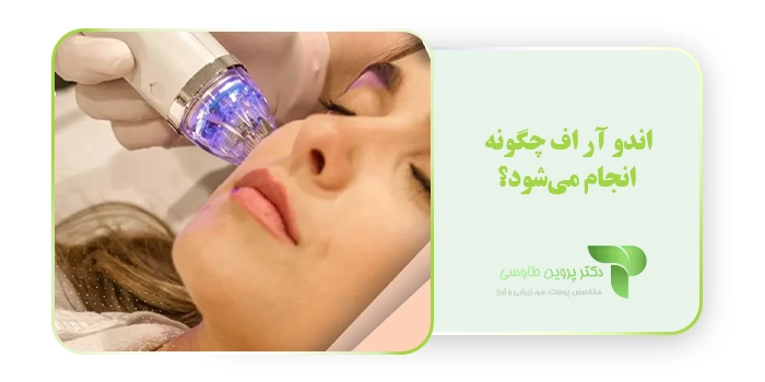 اندو آر اف چگونه انجام می‌شود؟