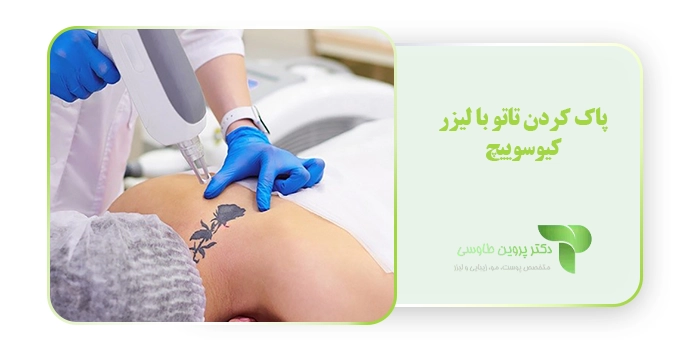 پاک کردن تاتو با لیزر کیوسوییچ